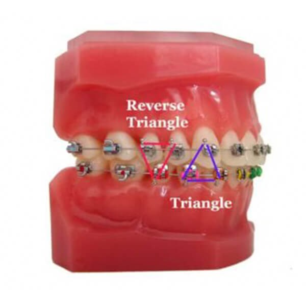 Elastics Triangle