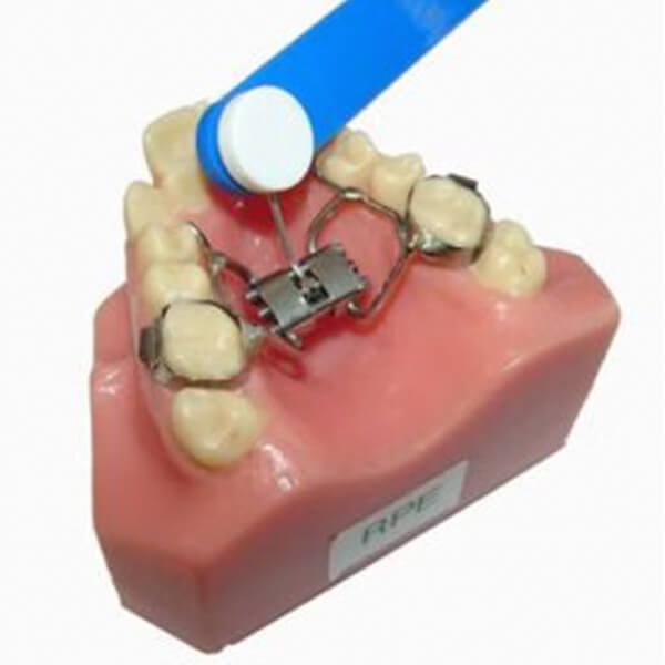 Rapid Palatal Expander